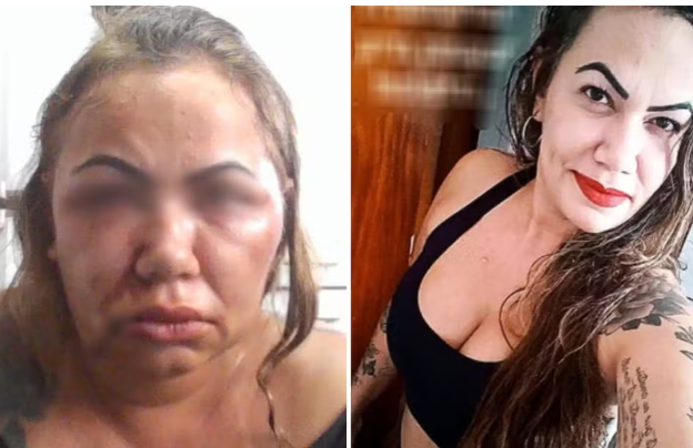 Professora que perdeu parte da audição após ser espancada durante 2 horas pelo ex diz que só dorme a base de remédios: 'Tenho pesadelos'